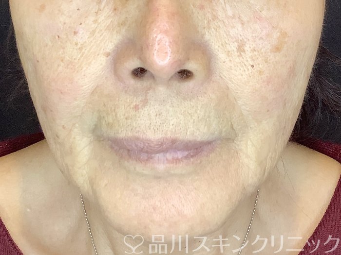 症例NO.65129のAFTER写真