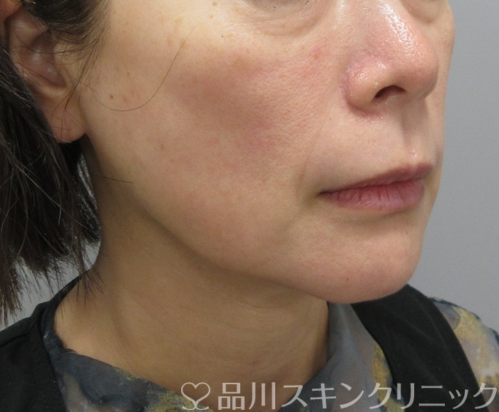 症例NO.74579のBEFORE写真