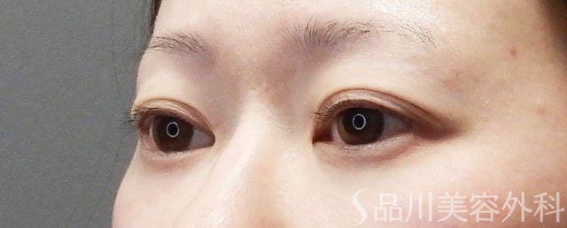 症例NO.73107のBEFORE写真