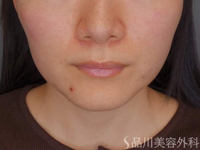 症例NO.72250のBEFORE写真