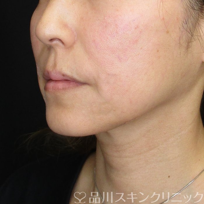 症例NO.74084のAFTER写真