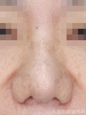 症例NO.73556のAFTER写真