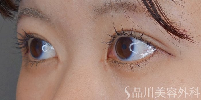 症例NO.71658のAFTER写真