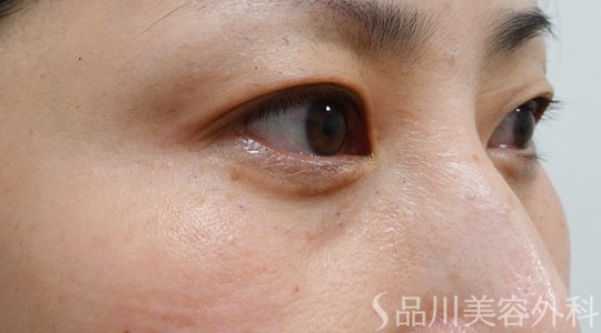 症例NO.72627のAFTER写真