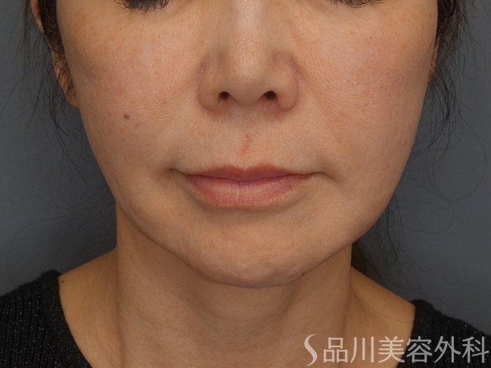 症例NO.74749のBEFORE写真