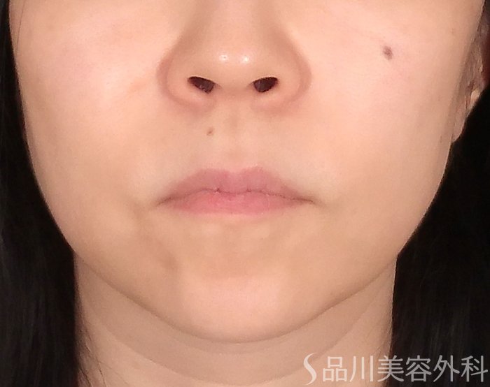 症例NO.70416のAFTER写真