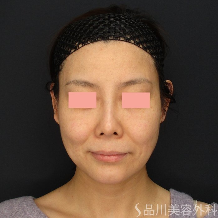 症例NO.69960のBEFORE写真