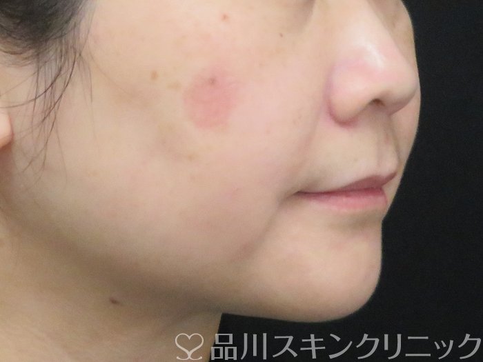 症例NO.69438のAFTER写真