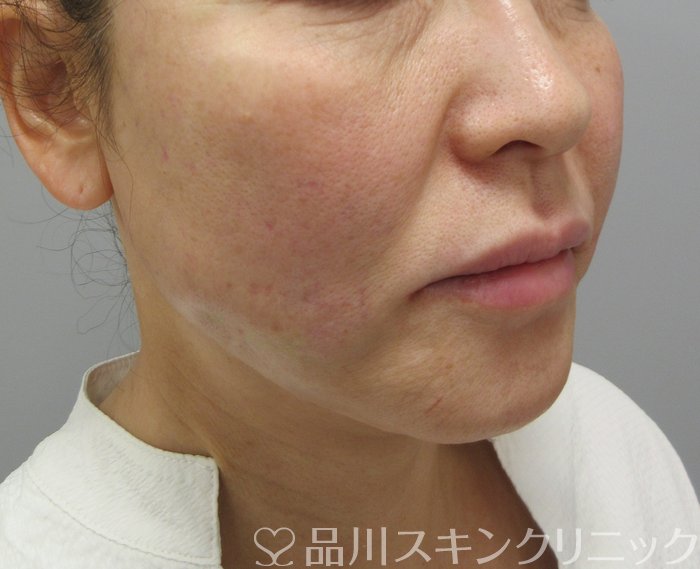 症例NO.73738のAFTER写真