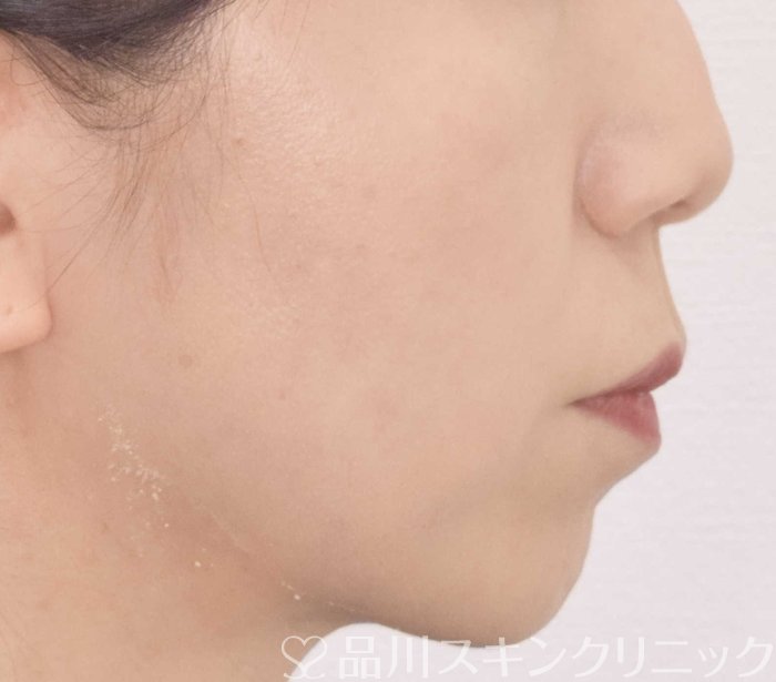 症例NO.72316のAFTER写真