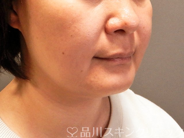症例NO.70314のBEFORE写真