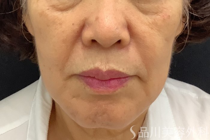 症例NO.71242のBEFORE写真