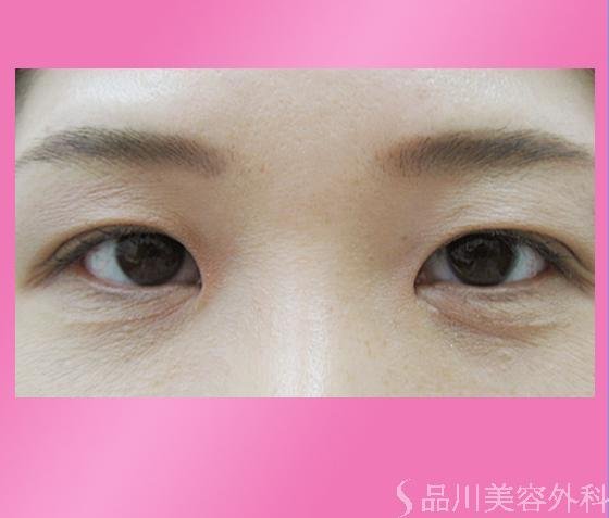 症例NO.815のAFTER写真
