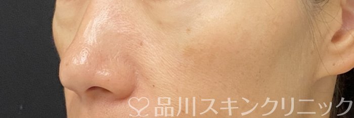 症例NO.74146のAFTER写真