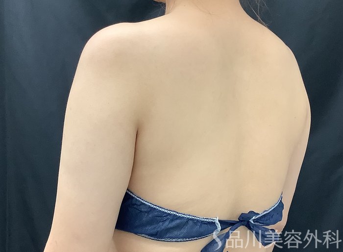 症例NO.67993のAFTER写真