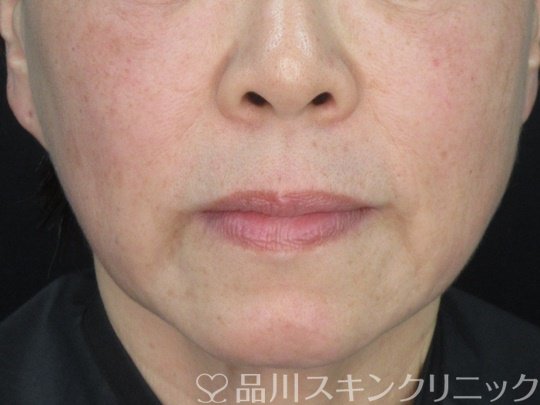 症例NO.75220のBEFORE写真