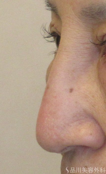 症例NO.74185のBEFORE写真