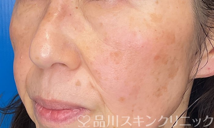 症例NO.74752のBEFORE写真