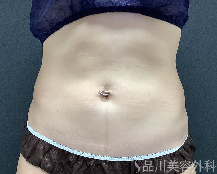 症例NO.75347のAFTER写真