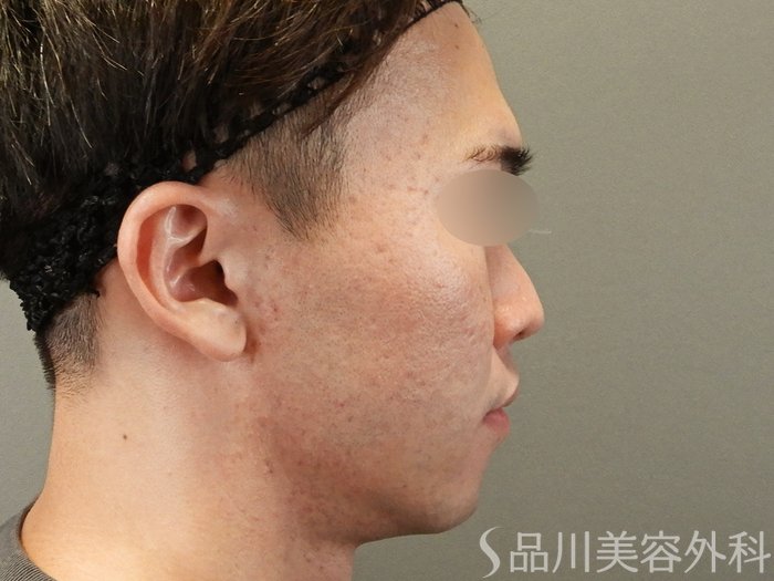 症例NO.67264のBEFORE写真