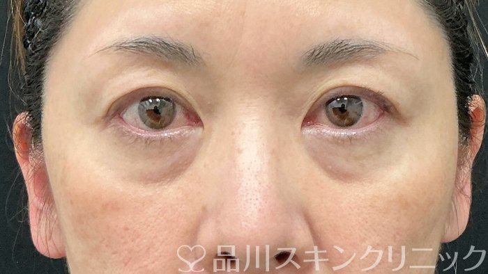 症例NO.74278のBEFORE写真