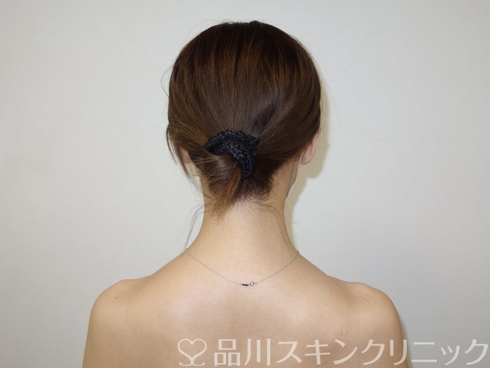 症例NO.73124のAFTER写真