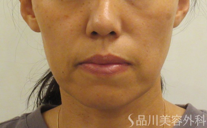 症例NO.71956のBEFORE写真