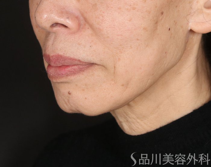 症例NO.72897のBEFORE写真