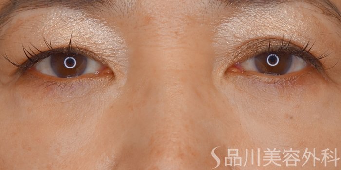 症例NO.72222のAFTER写真