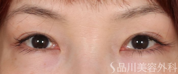 症例NO.73461のBEFORE写真