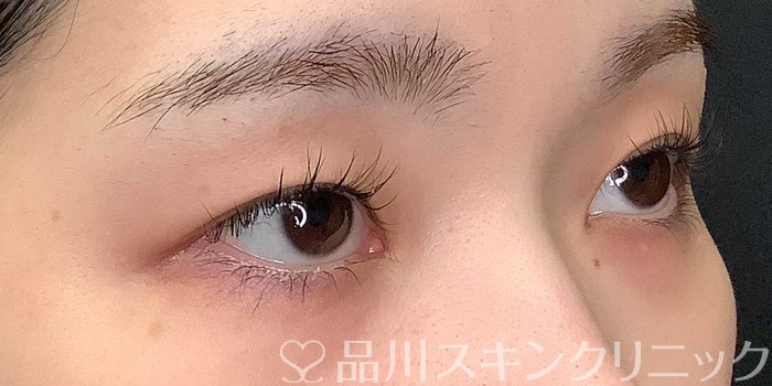 症例NO.69704のBEFORE写真