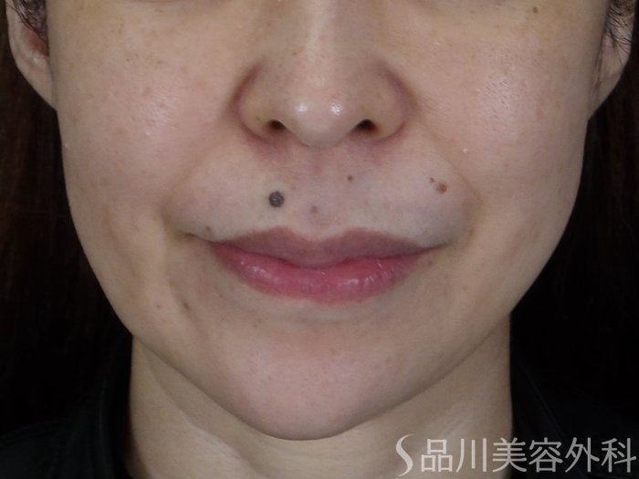 症例NO.71333のBEFORE写真