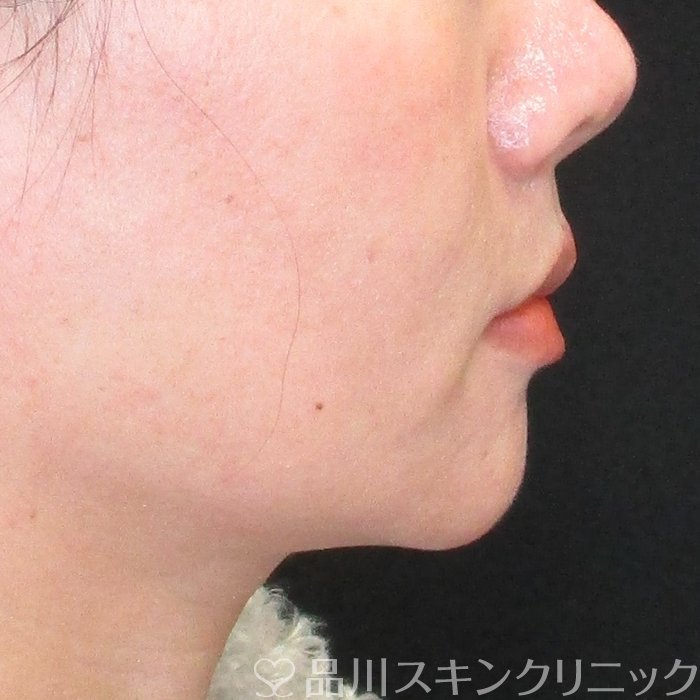症例NO.73941のBEFORE写真