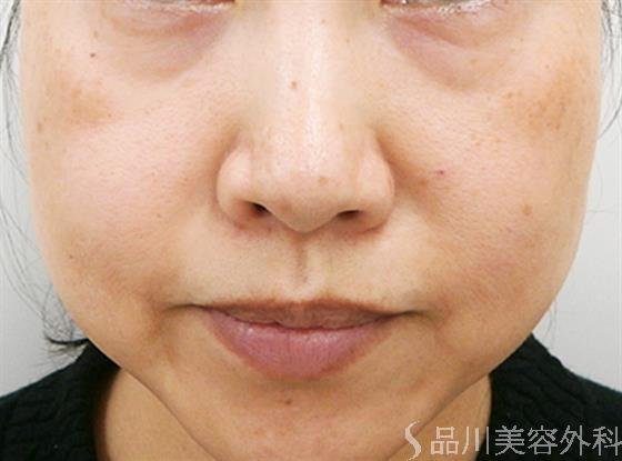 症例NO.24851のBEFORE写真