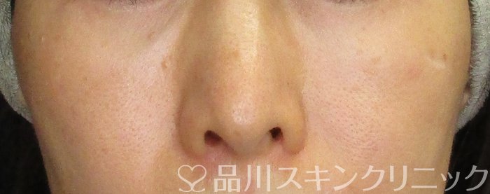 症例NO.74765のAFTER写真