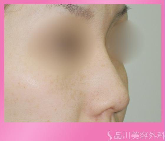 症例NO.2060のBEFORE写真