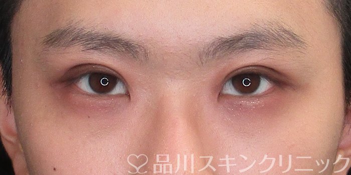 症例NO.73088のAFTER写真