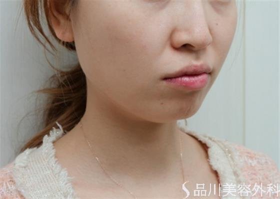 症例NO.47381のBEFORE写真