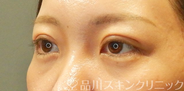 症例NO.66571のAFTER写真