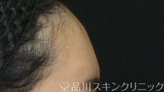 症例NO.72293のAFTER写真