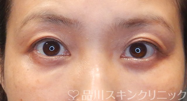 症例NO.75250のAFTER写真