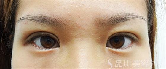 症例NO.25020のAFTER写真