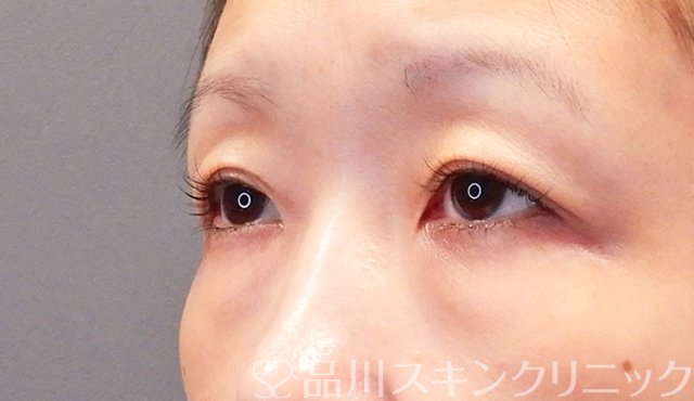 症例NO.75350のBEFORE写真