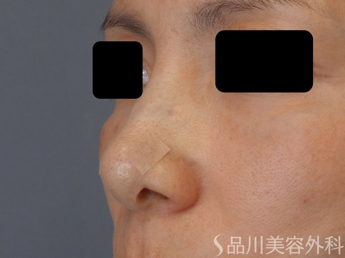 症例NO.72550のAFTER写真