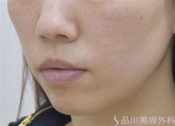 症例NO.47340のBEFORE写真