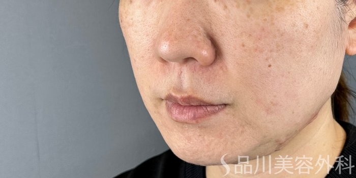 症例NO.71962のBEFORE写真