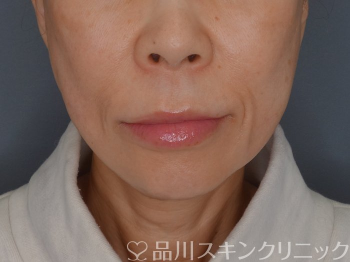 症例NO.72448のAFTER写真