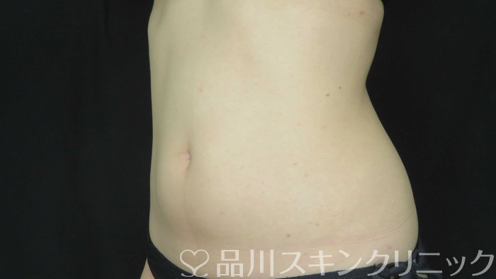 症例NO.72097のAFTER写真