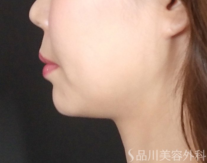 症例NO.69534のAFTER写真
