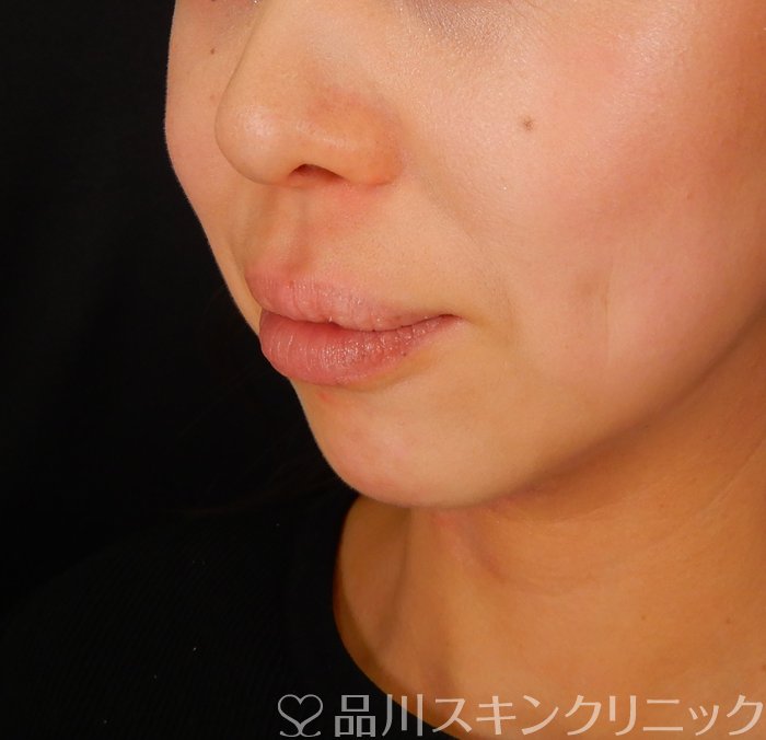 症例NO.66997のBEFORE写真